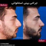 جراحی بینی استخوانی در اصفهان