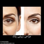جراحی زیبایی پلک در اصفهان