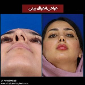 جراحی بینی کج - دکتر علیرضا مجلسی - dralirezamajlesi.com