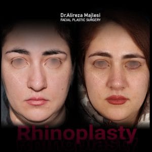 رینوپلاستی بینی گوشتی - دکتر مجلسی