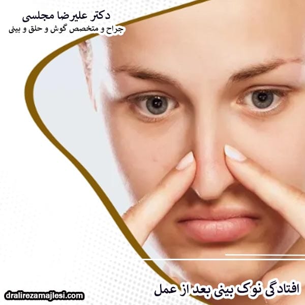 افتادگی نوک بینی بعد از عمل