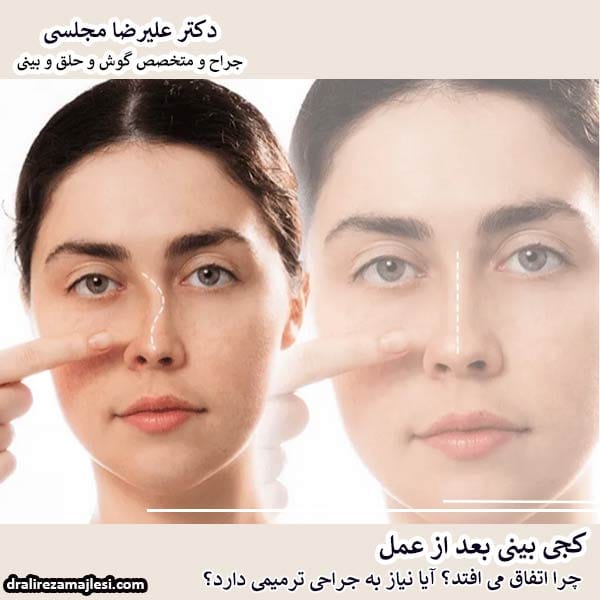کجی بینی بعد از عمل - دکتر علیرضا مجلسی