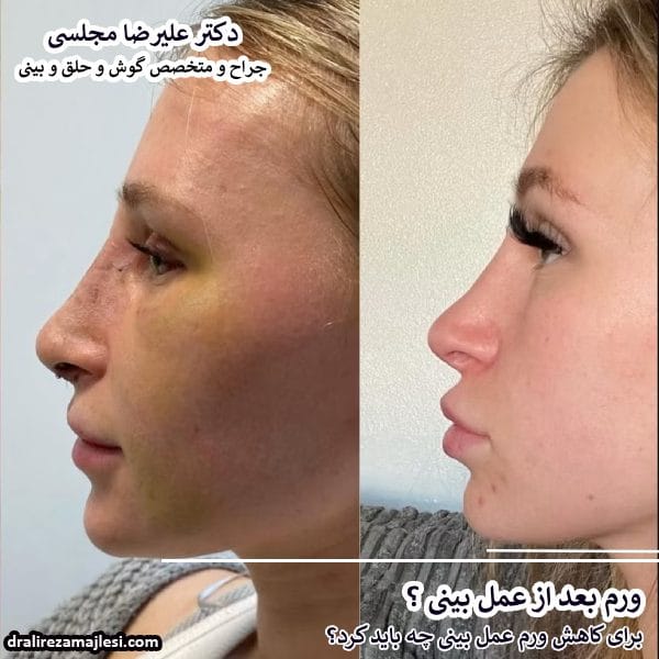 قبل و بعد از ورم بعد عمل بینی