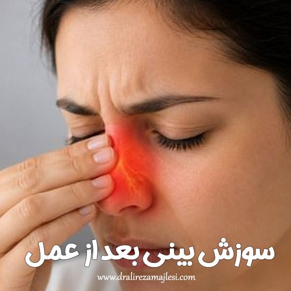 سوزش بینی بعد از عمل + دکتر علیرضا مجلسی