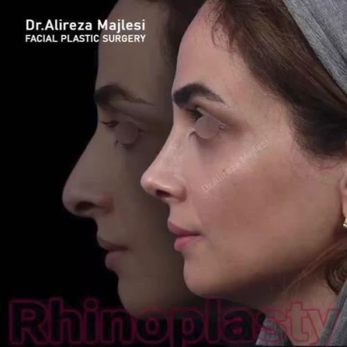 rhinoplasty-185