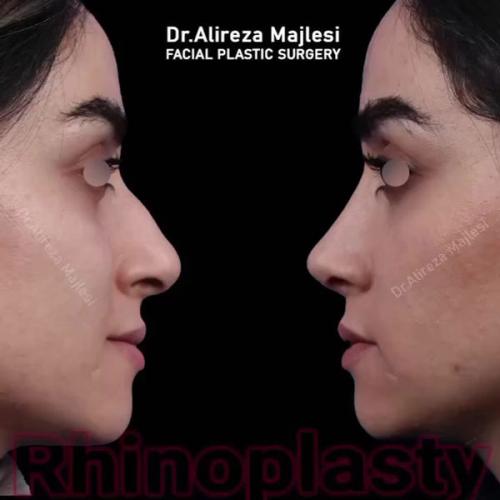 rhinoplasty-186