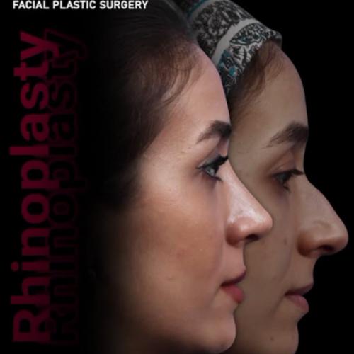 rhinoplasty-201