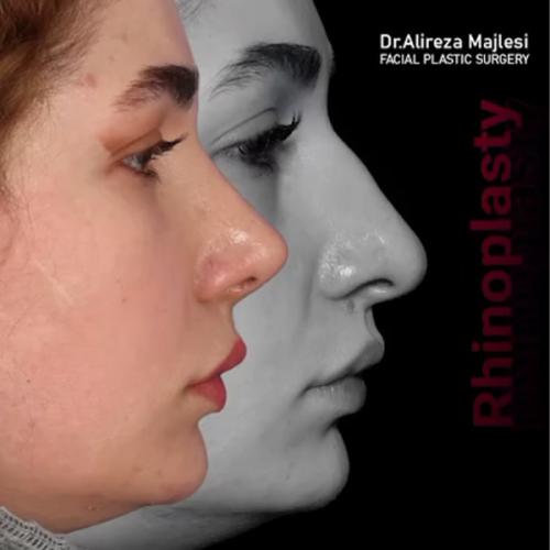 rhinoplasty-202