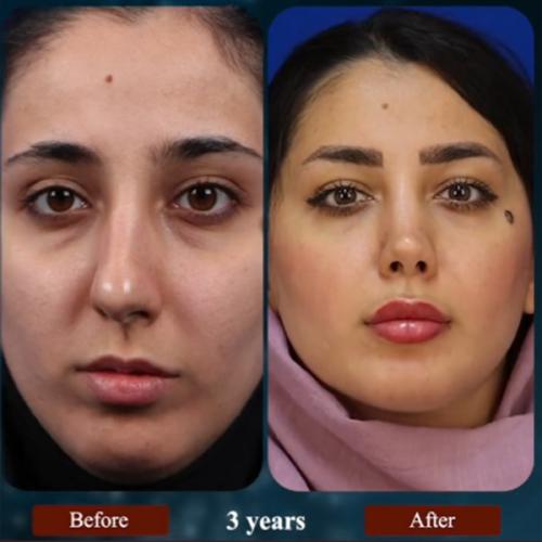 rhinoplasty-203