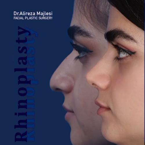 rhinoplasty-206