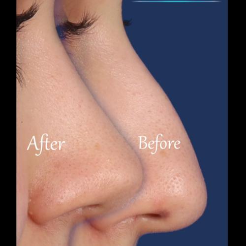 rhinoplasty-207