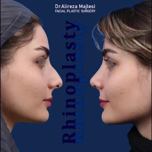 rhinoplasty-208