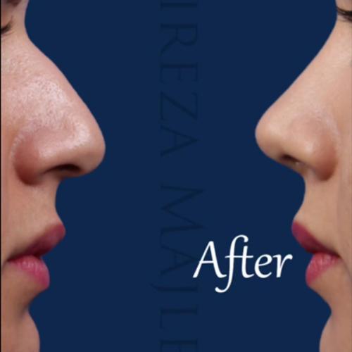 rhinoplasty-209