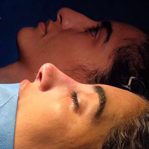 rhinoplasty-214