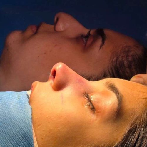 rhinoplasty-215
