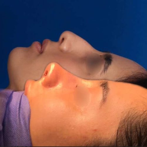 rhinoplasty-216