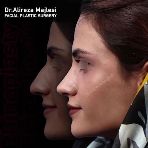 rhinoplasty187