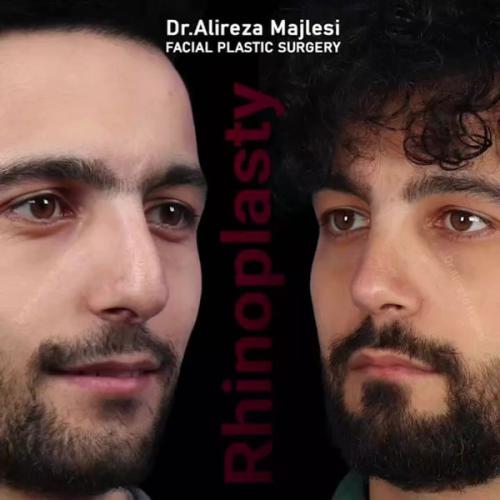 rhinoplasty189