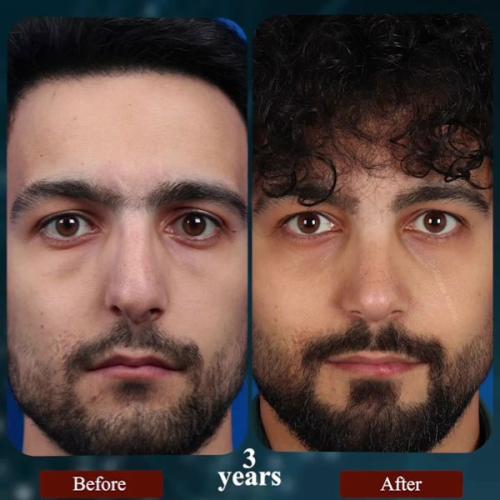 rhinoplasty190