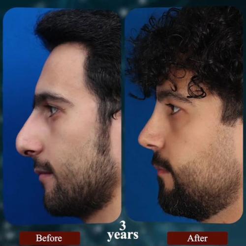 rhinoplasty193