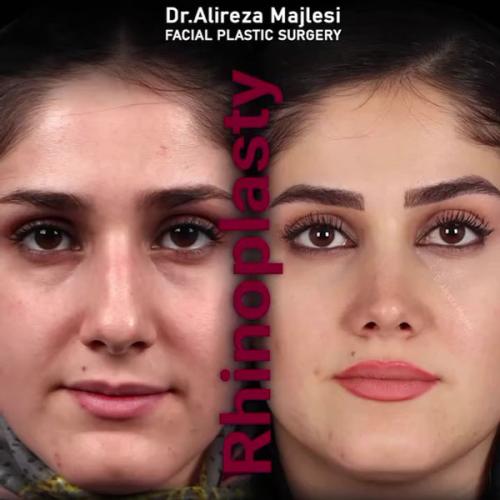 rhinoplasty195