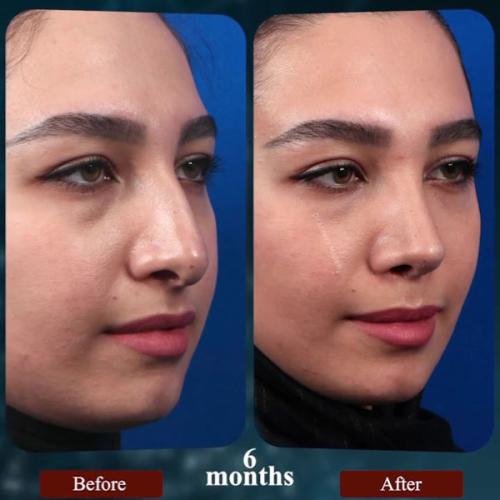 rhinoplasty198