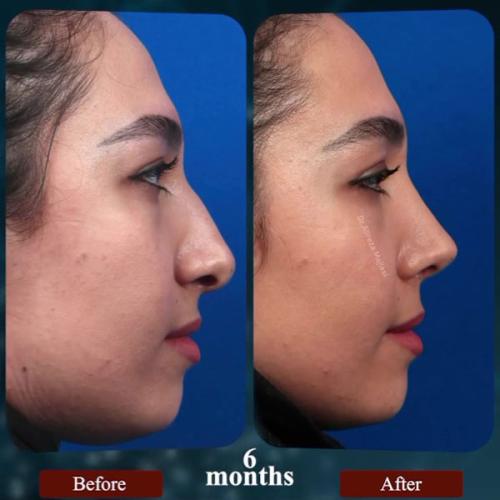 rhinoplasty199